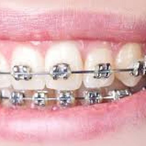 Apparecchio denti Roma.