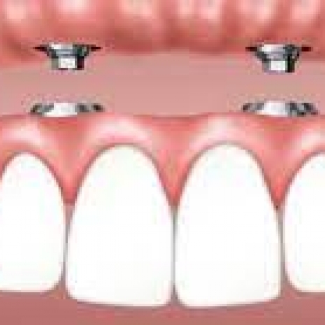 All on 4 Impianti Dentali (Straumann) 3500 €.