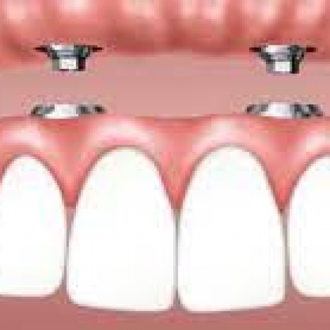 All on 4 Impianti dentali zirconio.