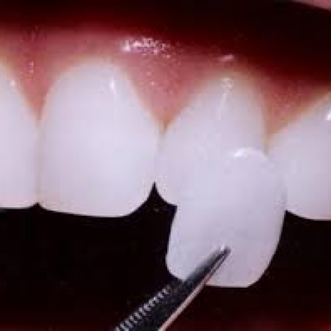 Faccetta dentali in ceramica 220 euro.