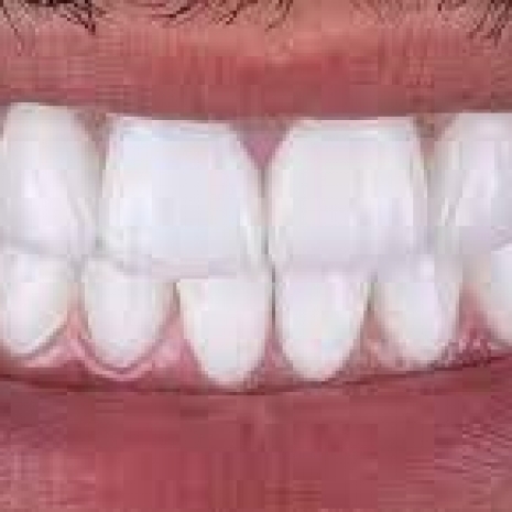 Veneers 350 euro.